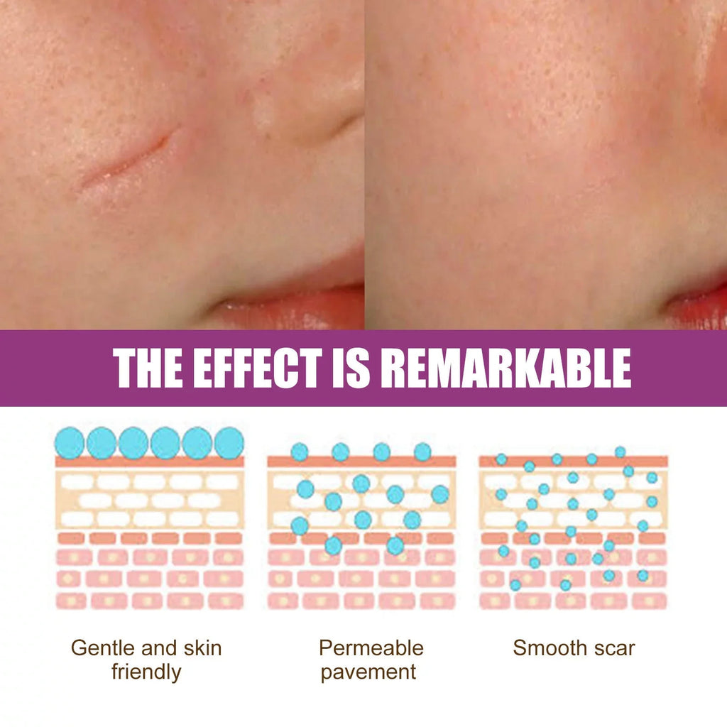 Scar Cream Removal Cream Scar Repair Skin and 2PCS Scar 50ml Removal Repair