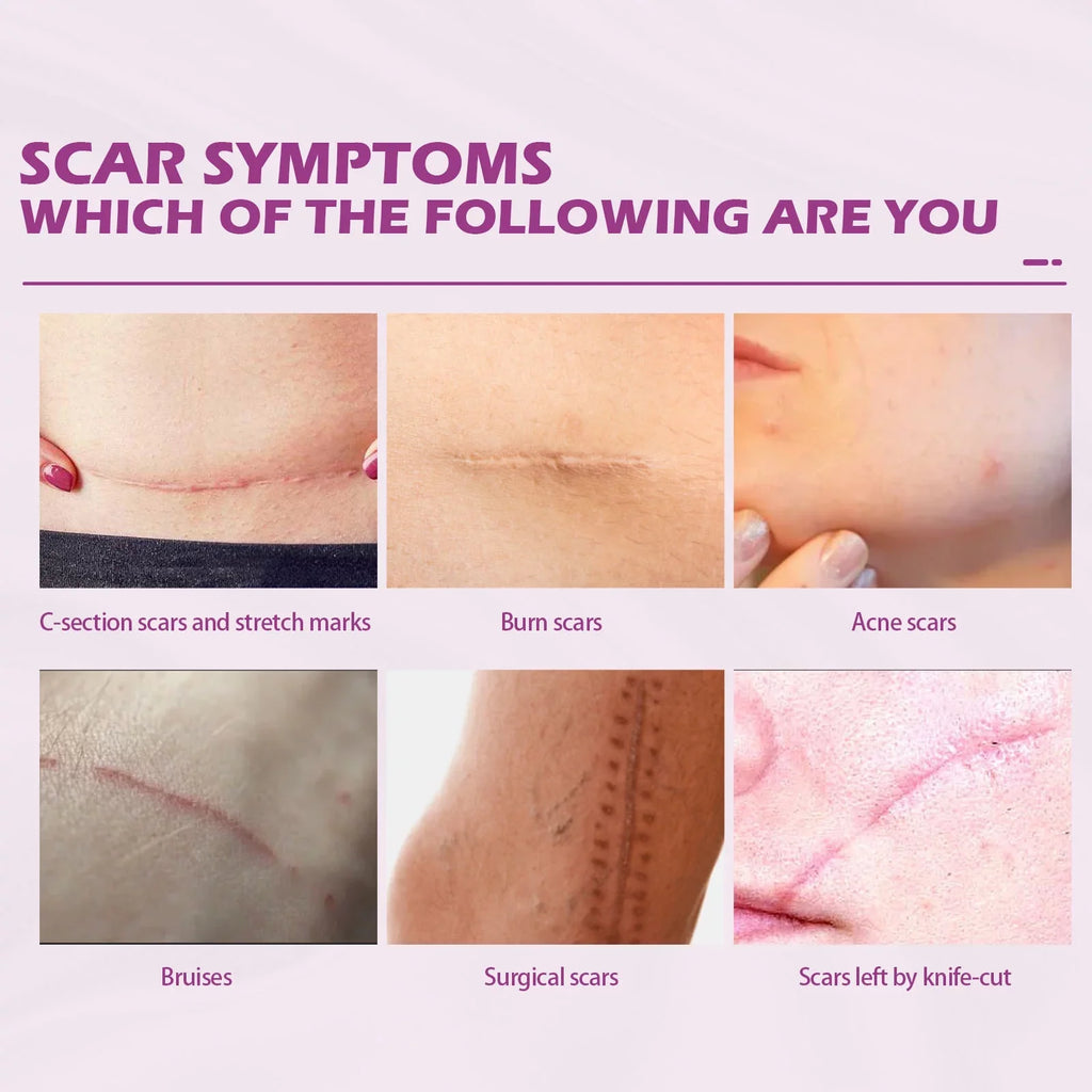 Scar Cream Removal Cream Scar Repair Skin and 2PCS Scar 50ml Removal Repair